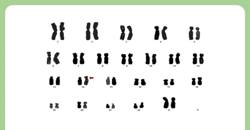Translocation Down Syndrome