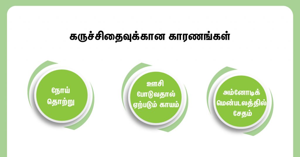 Miscarriage Risk After Amniocentesis