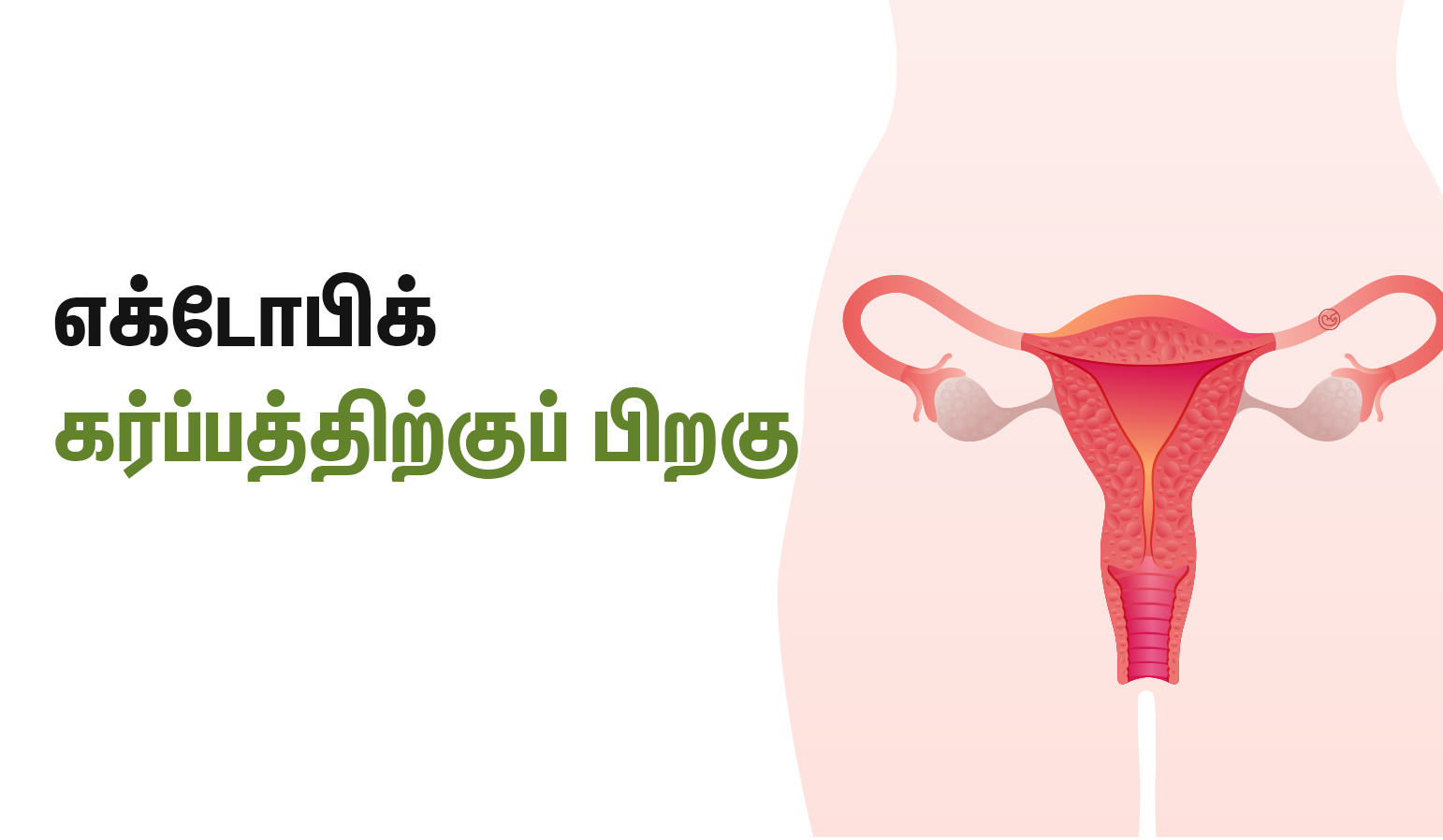 after ectopic pregnancy