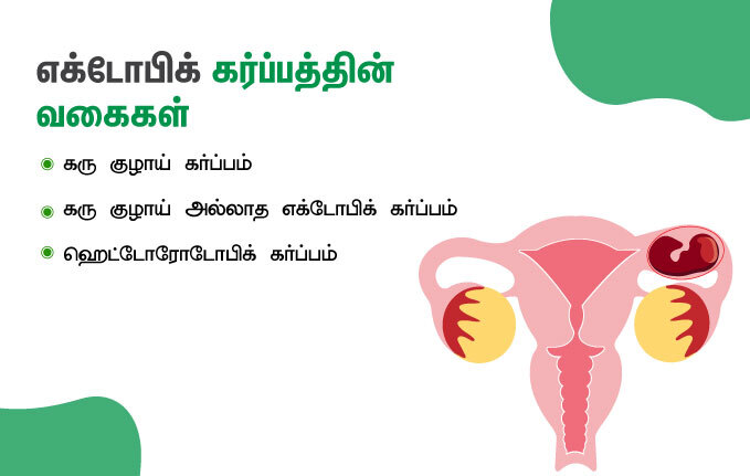 ectopic pregnancy 3 types