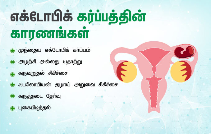 ectopic pregnancy reasons