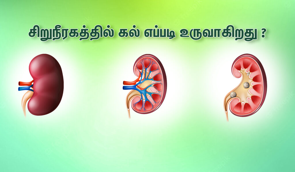 How Do Kidney Stones Form
