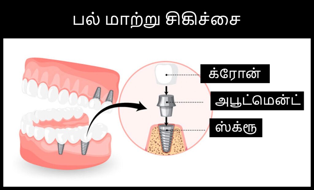 Tooth Decay Stages